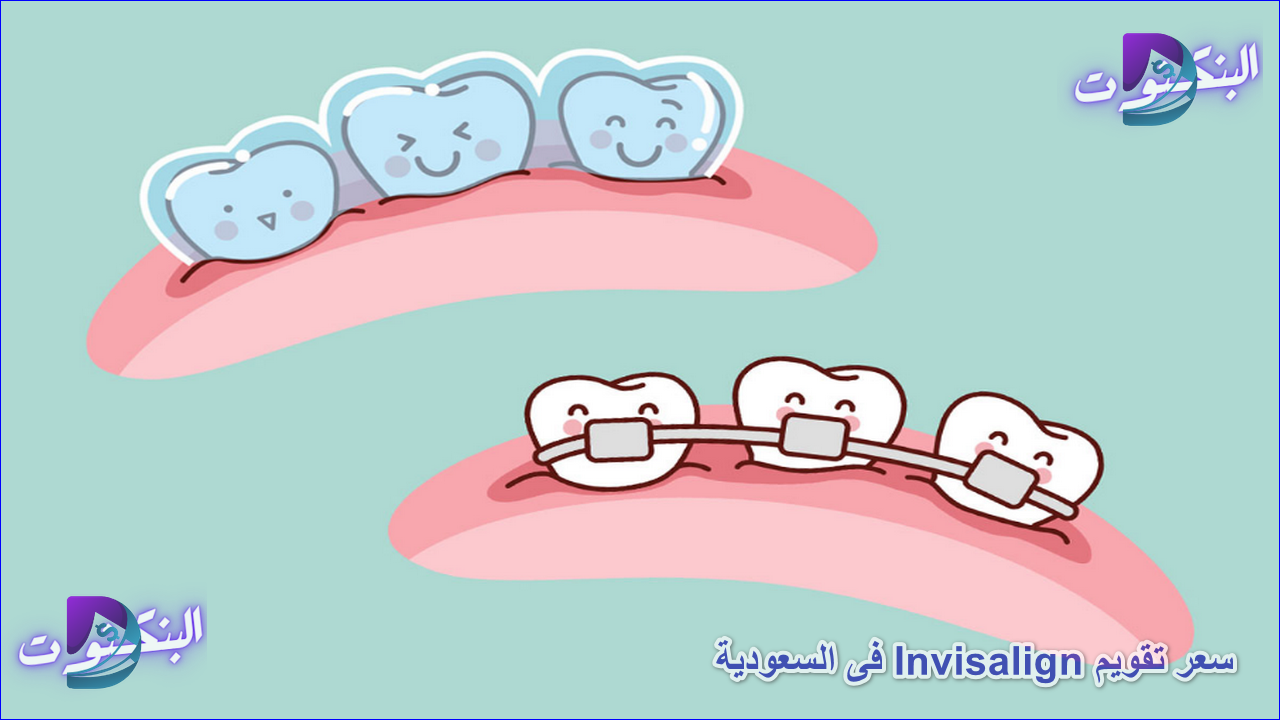 سعر تقويم Invisalign فى السعودية